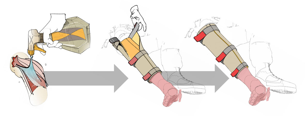 drawing of Battelle's ACCSIL wrap technology